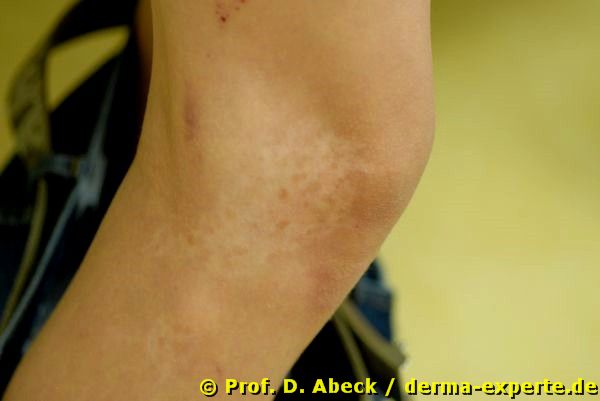 Poliosis als Manifestationsform der Vitiligo